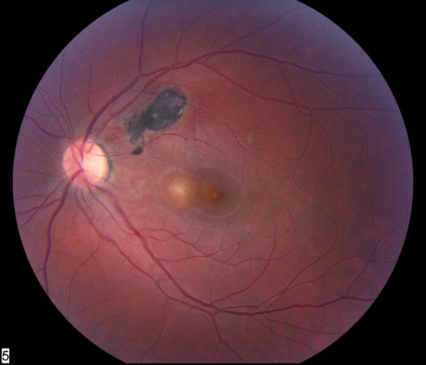 Ocular Histoplasmosis Syndrome